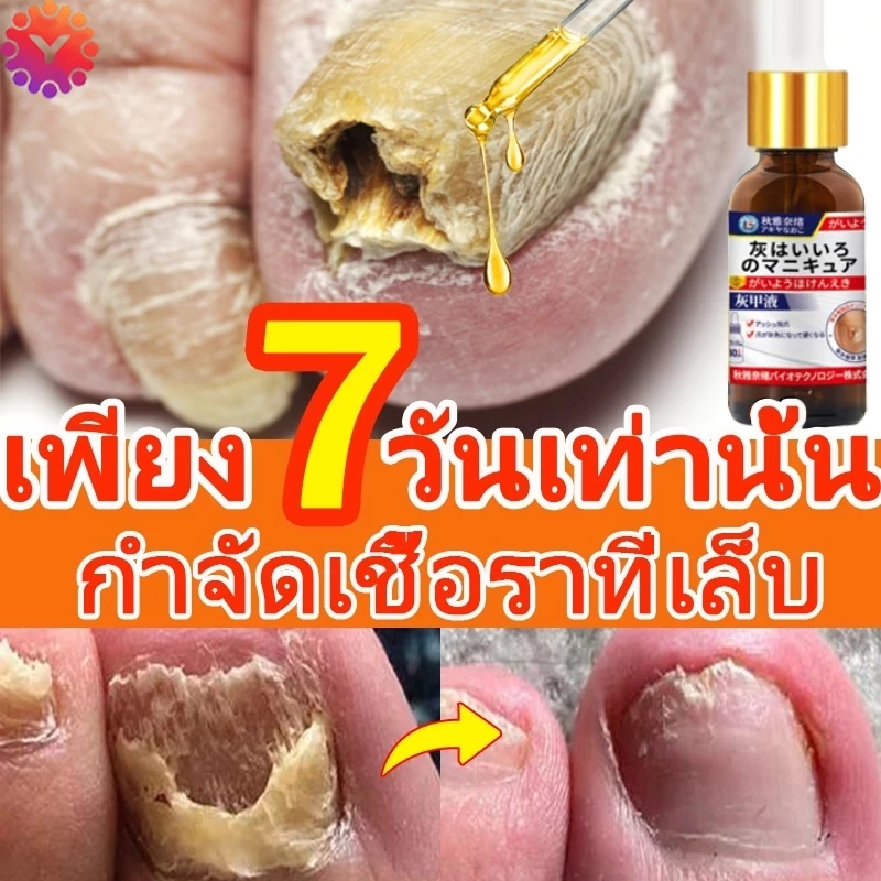 【ผู้ขายในท้องถิ่น】Nail Repair Essenceเซรั่มบำรุงเล็บ ลากับเล็บเสีย ไม่ทำร้ายเล็บดี ห่างกับปัญหาเล็บ30ml