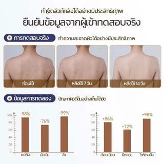ครีมอาบน้ำลดสิว กำจัดไรเจลอาบน้ํา 500ml ต่อต้านเชื้อราแก้คัน ให้ความชุ่มชื้นอ่อนโยน กลิ่นหอมติดทน ลดสิว กำจัดไร คุมน้