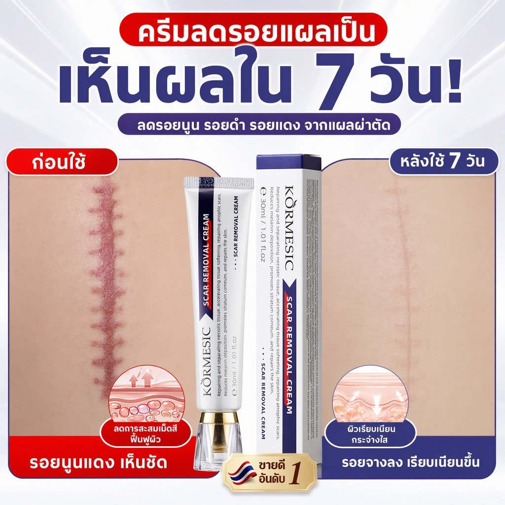 ครีมทาแผลเป็นขนาด30ก ลบรอยแผลเป็นสีดำ ทำให้รอยแผลไฟไหม้แตกลายจางลงได้ผลดี