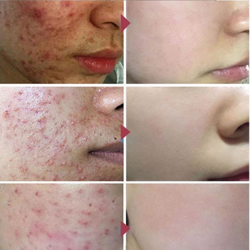 โฟมล้างหน้าใสขจัดสิวหัวดำ ทำความสะอาดลึกรูขุมขน รูปที่ 3