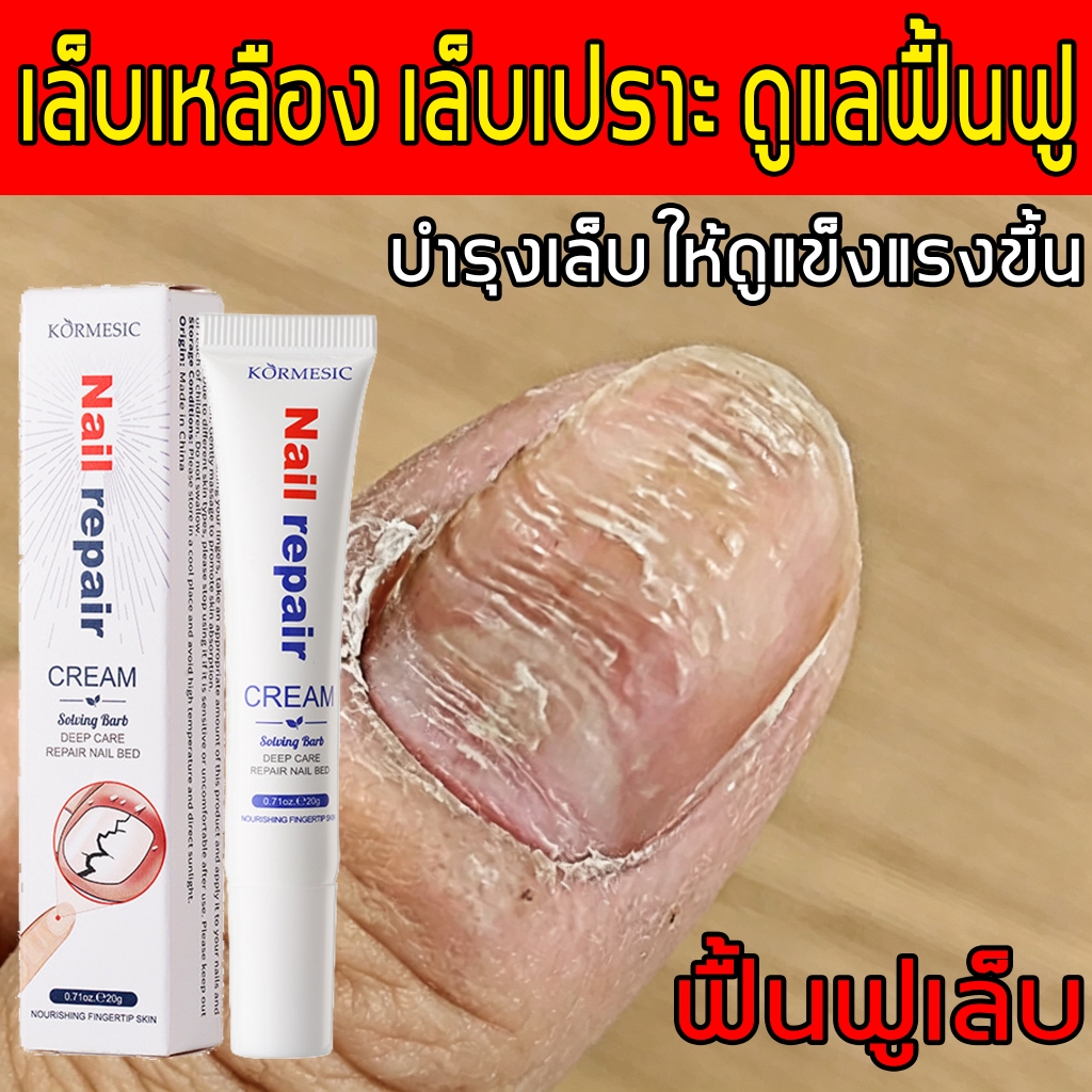 เห็นผลรวดเร็วภายใน 7 วัน ยาทาเชื้อราที่เล็บ เชื้อราเล็บ เล็บเสีย สูตรอ่อนโยน ไม่เหนียวเหนอะหนะ ไม่ระคายเคือง ใช้ง่าย