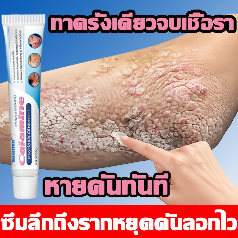 🔥บรรเทาอาการคัน🔥ครีมแก้คัน ครีมทาผิว กลาก เกลื้อน ผิวหนังอักเสบ ผื่นคัน ผิวแห้งลอก ช่วยดูแลผิว สูตรธรรมชาติ อ่อนโยน