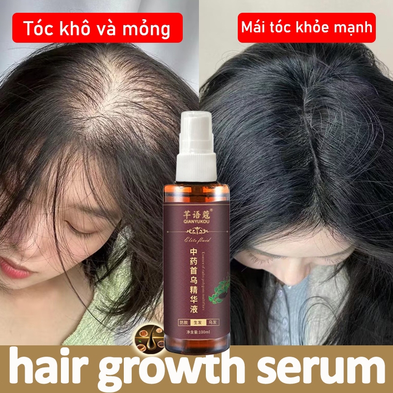 Hair Growth Spray Serum Hair Growth Essence กระตุ ้ นการเจริญเติบโตของเส ้ นผมลดผมร ่ วง 100ml บํารุงหนังศีรษะเพื ่ อกระตุ ้ นการเจริญเติบโตของเส ้ นผม